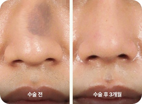 수술전. 수술 후 3개월