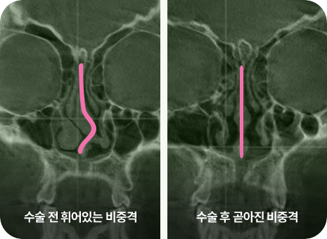 수술 전 휘어있는 비중격. 수술 후 곧아진 비중격