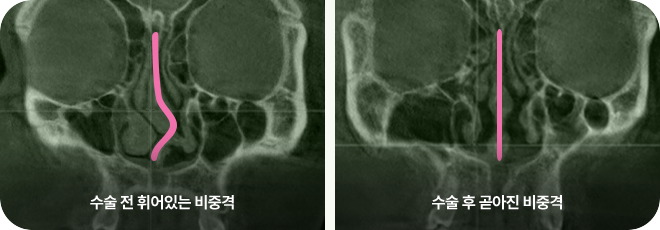 수술 전 휘어있는 비중격. 수술 후 곧아진 비중격