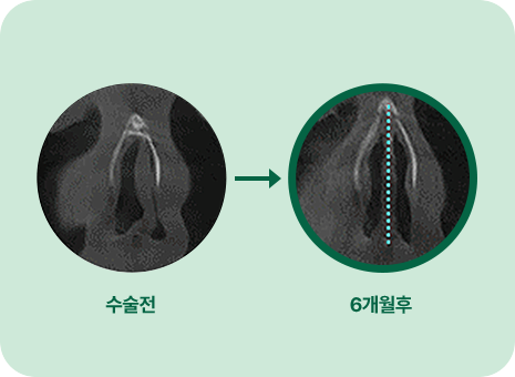 수술전. 6개월 후