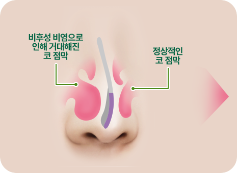 비후성 비염으로 인해 거대해진 코 점막. 정상적인 코 점막
