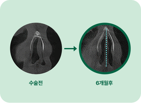 수술전. 6개월 후