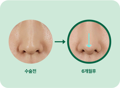 수술전. 6개월 후