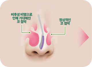 비후성 비염으로 인해 거대해진 코 점막. 정상적인 코 점막