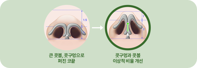 큰 콧볼 콧구멍으로 퍼진 코끝. 콧구멍과 콧볼 이상적 비율개선