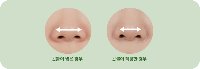 콧볼이 넓은 경우. 콧볼이 적당한 경우.