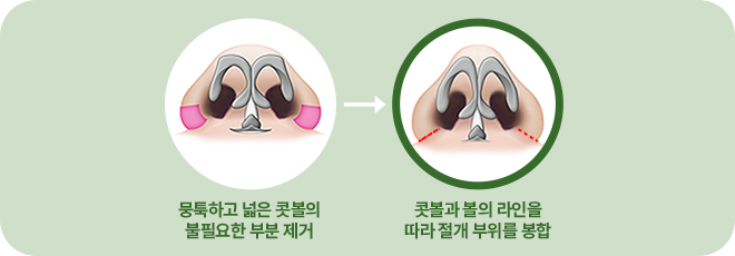 뭉툭하고 콧볼이 넓은 코의 불필요한 콧볼살 제거. 콧볼과 볼의 라인을 따라 절개부위를 봉합.