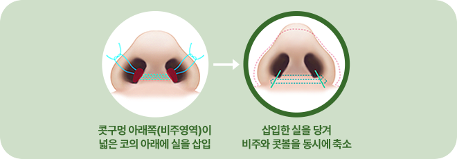 콧구멍 아래쪽(비주영역)이 넓은 코의 아래에 실을 삽입. 삽입한 실을 당겨 비주와 콧볼을 동시에 축소.