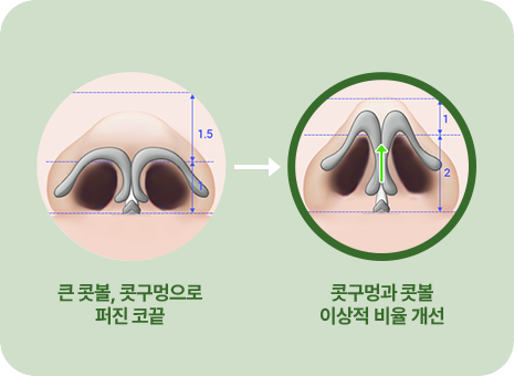 큰 콧볼 콧구멍으로 퍼진 코끝. 콧구멍과 콧볼 이상적 비율개선