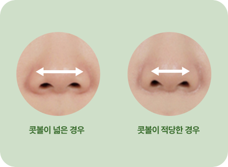 콧볼이 넓은 경우. 콧볼이 적당한 경우.