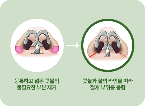 뭉툭하고 콧볼이 넓은 코의 불필요한 콧볼살 제거. 콧볼과 볼의 라인을 따라 절개부위를 봉합.