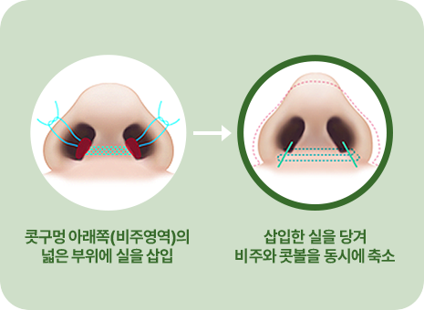 콧구멍 아래쪽(비주영역)이 넓은 코의 아래에 실을 삽입. 삽입한 실을 당겨 비주와 콧볼을 동시에 축소.