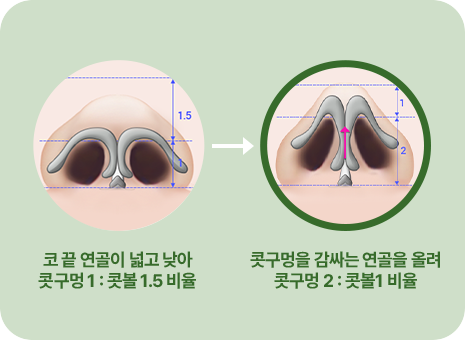 코 끝 연골이 넓고 낮아 콧구명1: 콧볼 1.5비율. 콧구명을 감싸는 연골을 올려 콧구명2:콧볼1비율