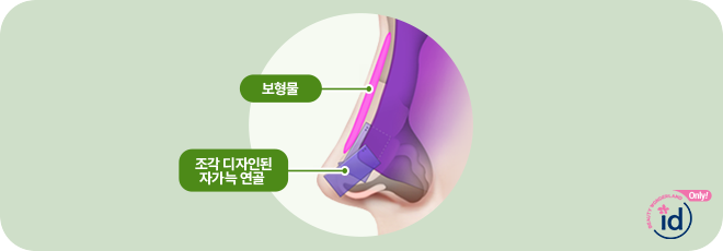 보형물. 조각디자인된 자가늑연골