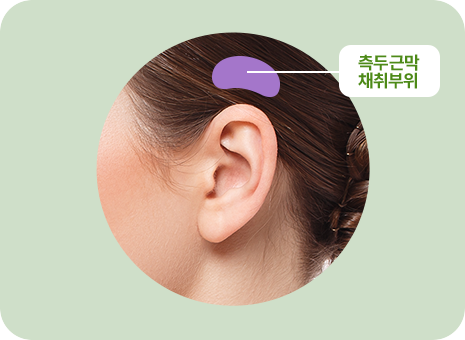 측두근막 채취부위