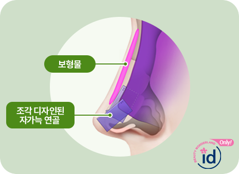 보형물. 조각디자인된 자가늑연골