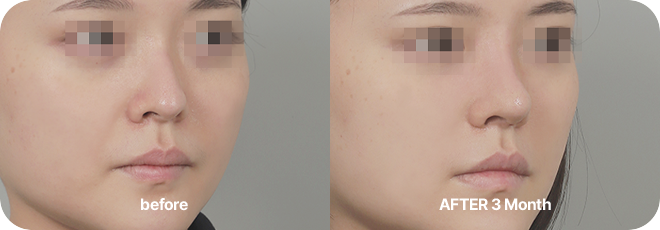 before. after 3 month