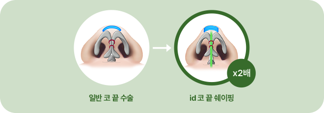 일반 코 끝 수술. id 코 끝 쉐이핑(x2배)