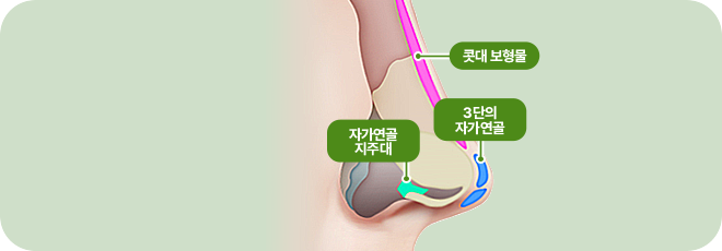 콧대 보형물. 자가연골 지주대. 3단의 자가연골