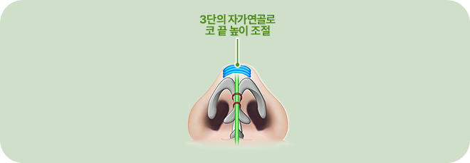3단의 자가연골로 코 끝 높이 조절