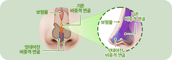 보형물. 기존 비중격연골. 잇대어진 비중격 연골