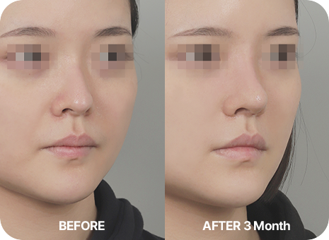 before. after 3 month