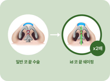 일반 코 끝 수술. id 코 끝 쉐이핑(x2배)