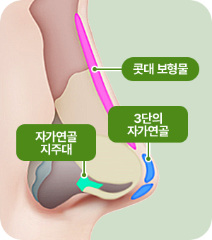 콧대 보형물. 자가연골 지주대. 3단의 자가연골