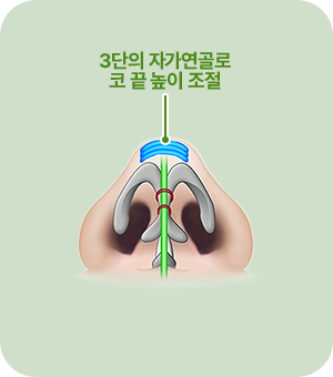 3단의 자가연골로 코 끝 높이 조절