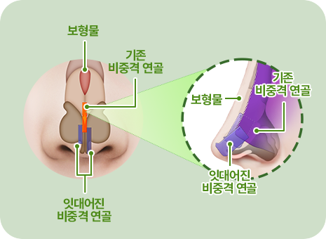 보형물. 기존 비중격연골. 잇대어진 비중격 연골