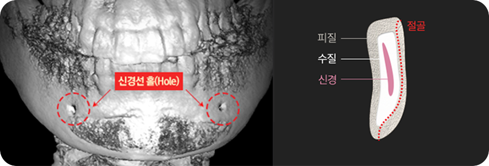 3D-CT와 내비게이션 시스템으로 안전성 확보