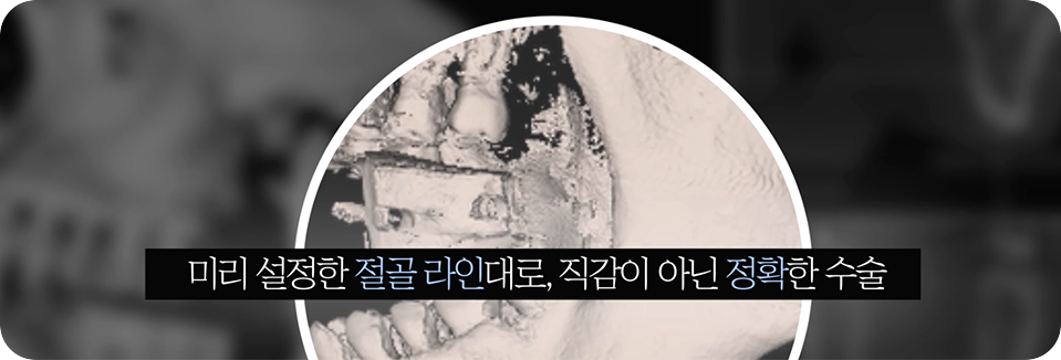 3D-CT와 내비게이션 시스템으로 안전성 확보