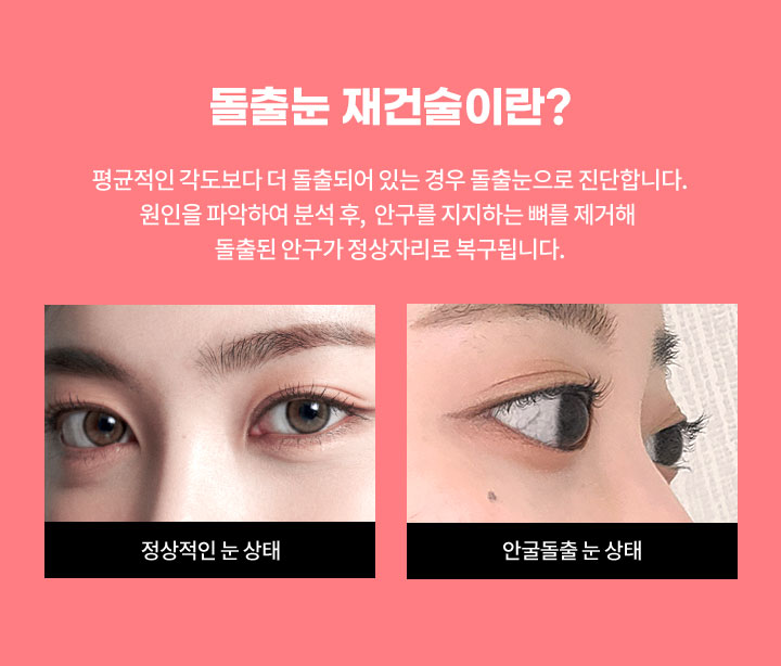 돌출눈 재건술이란?