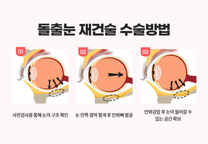 돌출눈 재건술 수술방법