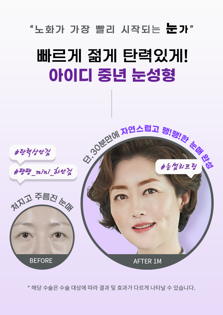 노화가 가장 빨리 시작되는 눈가 빠르게 젊게 탄력있게! 아이디 중년 눈성형