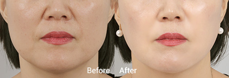 테일러 리프팅 Before and After1