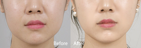 테일러 리프팅 Before and After2