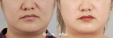 테일러 리프팅 Before and After3