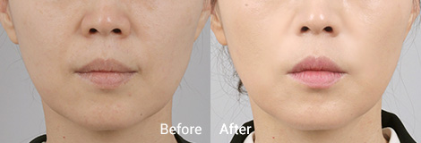 테일러 리프팅 Before and After5