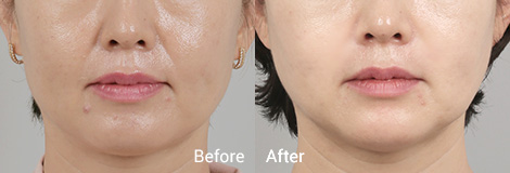 테일러 리프팅 Before and After6
