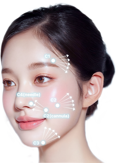 볼륨 리프팅 시술 부위를 표시한 얼굴 이미지