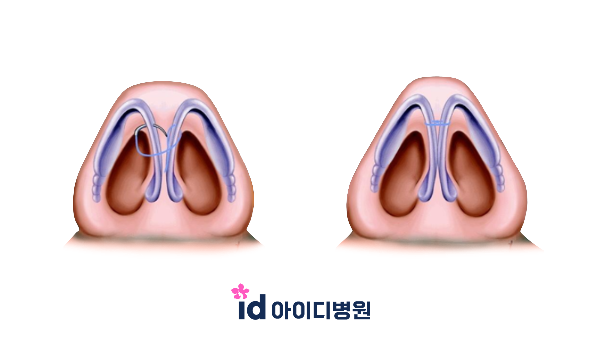 구축코 vs 들창코 수술 후 코끝이 들렸다고 해서 무조건 구축인 것은 아닙니다