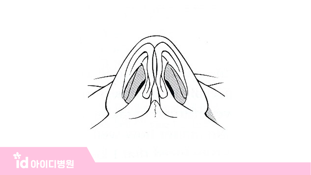 수술 후 괜찮았는데 4년 지나니까 코끝이 들렸어요