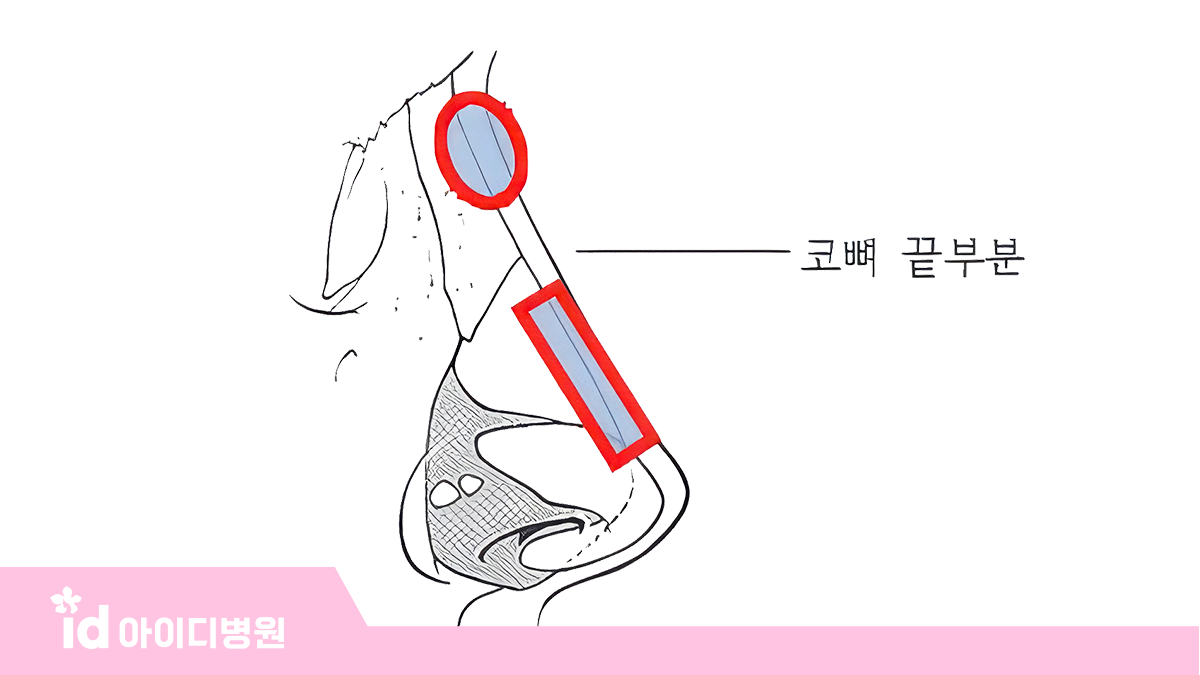 코끝 성형 + 자가연골 콧등 높이기