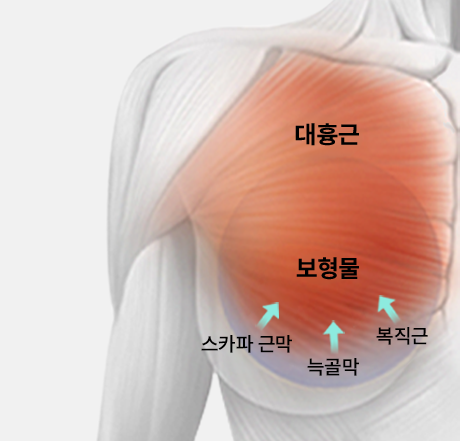 3중 타이트닝