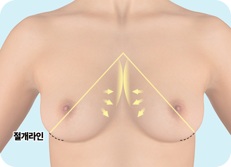 피치(복숭아) 절개법