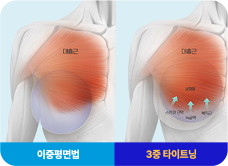3중 타이트닝 기법