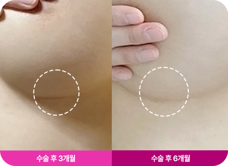 흉터 최소화
