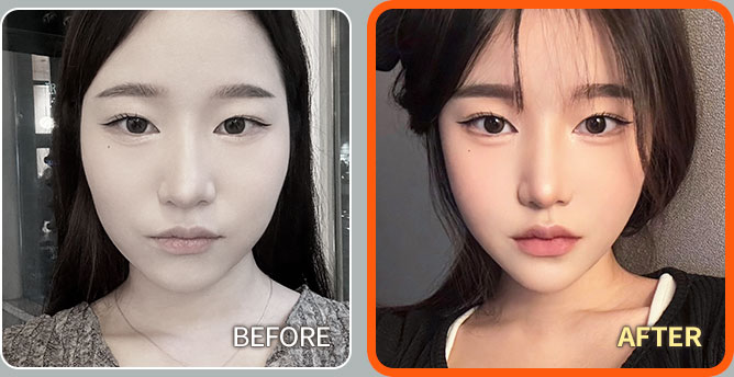 남자의 가슴고민, 이제는 여유증과 작별할 시간!