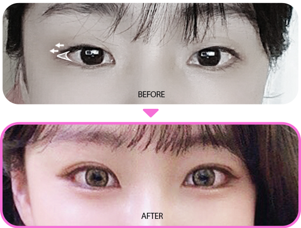 뒤트임